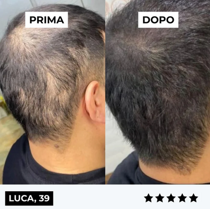 Sistema di micro-infusione per la ricrescita dei capelli di ClinSkin