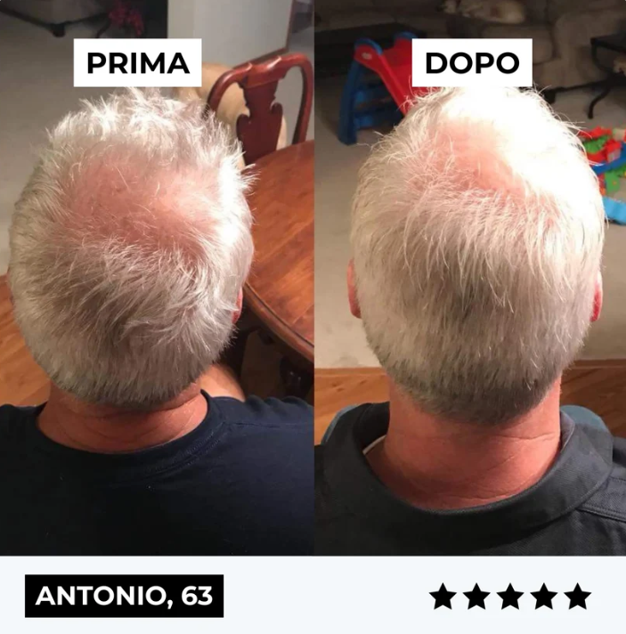 Sistema di micro-infusione per la ricrescita dei capelli di ClinSkin